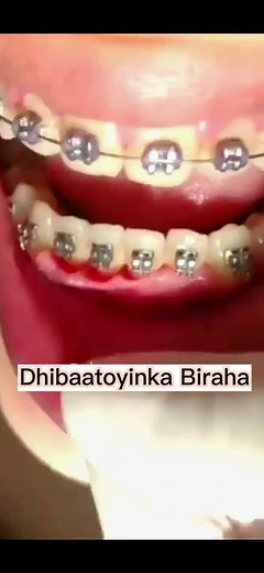 Dhibaatoyinka Biraha ilkaha😳 #dentist #muqdisho #somalidentist #somali #hargeisa #kenya #ethiopia #usa #ciridkaqodma #CapCut #dental #birahailkaha #ilkahabirah #borama #bosaso #newyear #2023