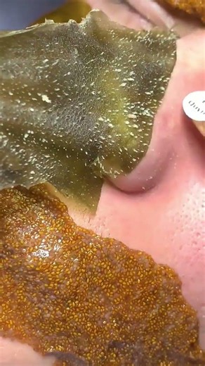 the face remove the pimple skin care #the pimple remover #magical #Relieve stress#Deep cleanse pores