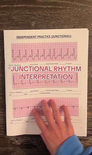 Junctional Rhythm Interpretation Explained