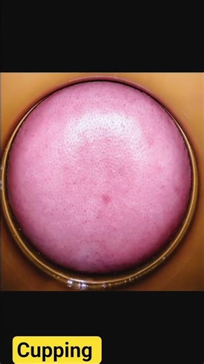 What Happens During Cupping Therapy #lifeisbutadream #ihavethisthingwithplants