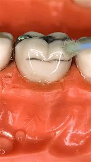 😱😱😱😱😱😱😱😱😱 #teeth #teethdecay #braces #brush