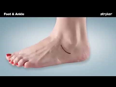 Stryker Foot and Ankle | SubFix™ Arthroeresis Implant Animation