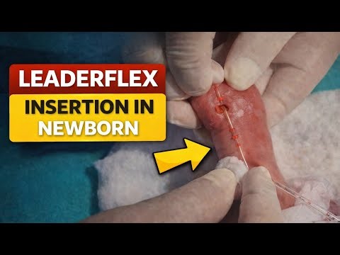 Leaderflex Insertion in Newborn | NICU Procedure | NICU Nursing Skill | Clinical Nursing Point|Vygon