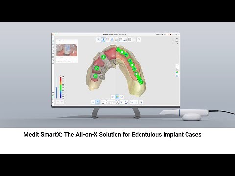 Medit SmartX : The All-on-X Solution for Edentulous Implant Cases