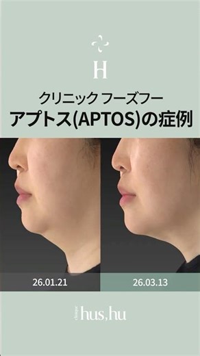 クリニック フーズフーでの糸リフト症例｜APTOS糸リフトで“整う”リフトアップ