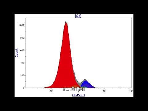 B-cell lymphoblastic leukemia by flow cytometry