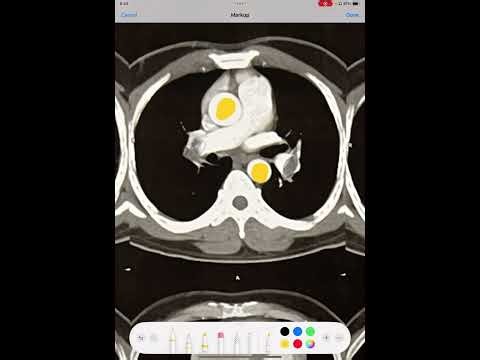 CTPA ( CT PULMONARY ANGIOGRAPHY) PULMONARY EMBOLISM