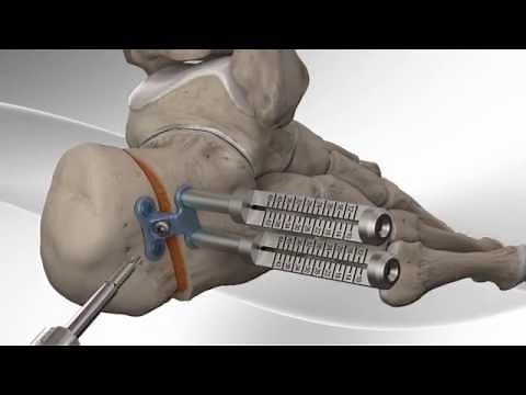 Flatfoot Repair with Arthrex® Calcaneus Step Plate