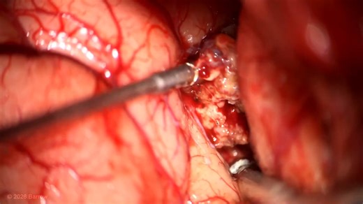 #502: Minipterional Craniotomy and Transsylvian-Anterior Transinsular Approach for Resection of a Cavernous Malformation in the Limen Insulae - All Videos - Seven Series Collection