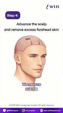 Dr. Chettasak | EP.37 – Scalp Advancement (Hairline Lowering Surgery) Without Hair Transplant