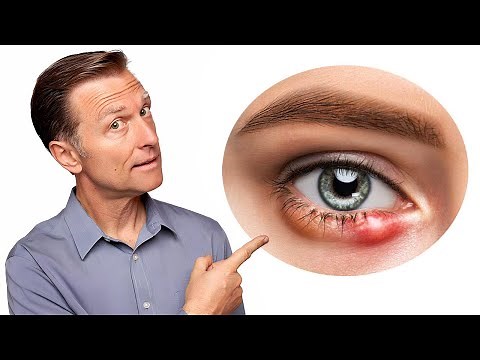 針眼的真正原因，如何快速消針眼？自然療法,柏格醫生 Dr Berg