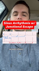 Understanding Sinus Arrhythmia with Junctional Escape findings on ECG | ECG Lectures with Reid