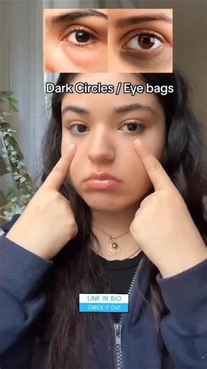 How to get rid of Dark Circles under your eyes!