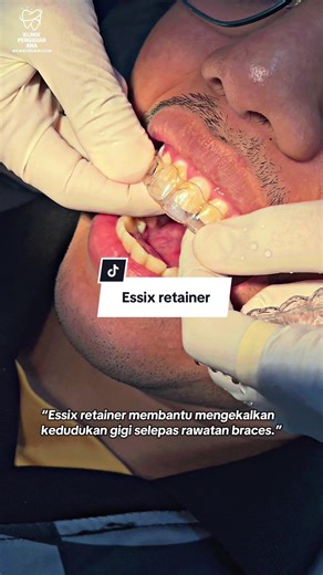 Baru buka braces ? Jom dapatkan Essix retainer anda di Klinik Pergigian Ana Shah Alam! 😍✨ #essixretainer #fypp #fypシ゚viral #fyppppppppppppppppppppppp #seksyen23shahalam