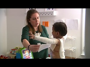 Butterfly child: Rare skin disorder affects Chapel Hill 4-year-old