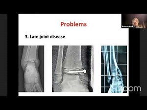 Distal Tibia and Transitional Fractures