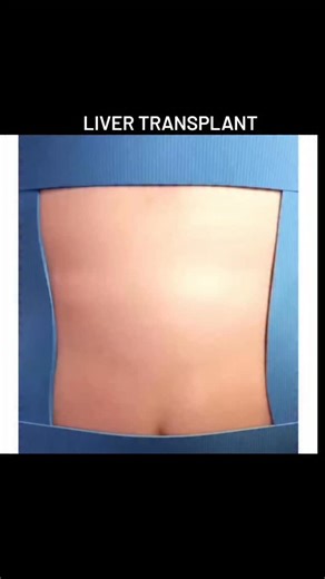 Dreamsanddramas Nspgk on Instagram: "A liver transplant is a surgery to replace a diseased liver with a healthy one from a donor. It is a life-saving option for people with end-stage liver disease or acute liver failure, often caused by conditions like cirrhosis, hepatitis, or alcohol-related liver disease. The new liver can come from a deceased donor, or a living donor can donate a part of their liver, as the liver is the only organ that can regenerate. What a liver transplant is A surgical pro