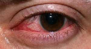 Eye injuries during general anaesthesia - Alchetron, the free social encyclopedia
