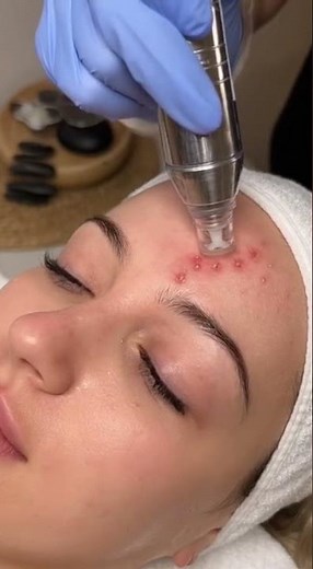 Forehead Acne Cluster Vacuum Sweep – Zen Spa ✨