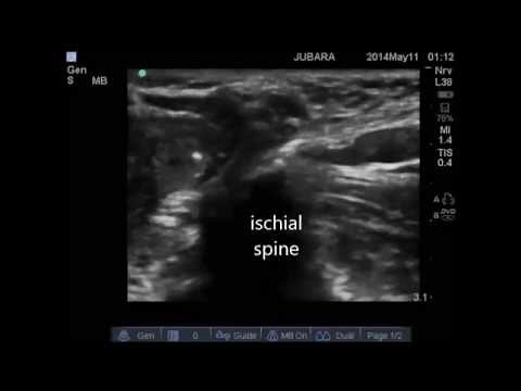 ultrasound guided pudendal nerve block