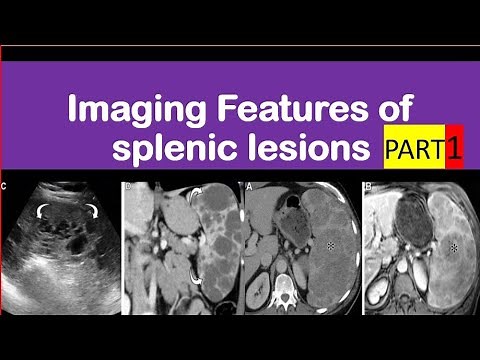 Cystic splenic lesions
