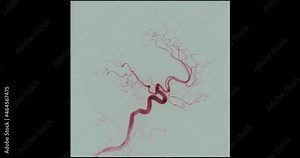Cerebral angiography uses a cathetear, x-ray imaging guidance and an injection of contrast to blood vessels in the brain for abnormalities such as aneurysms and disease such as atherosclerosis (plaqu