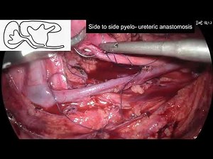 Laparoscopic Pyeloplasty in anomalous kidney