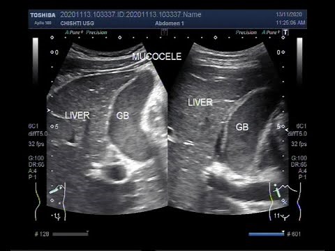 Ultrasound Video showing Gallbladder sludge and Mucocele of the Gallbladder.