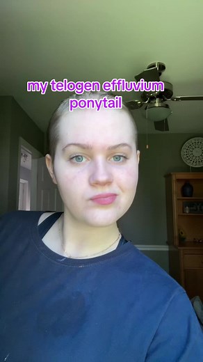 Managing Greasy Hair During Telogen Effluvium