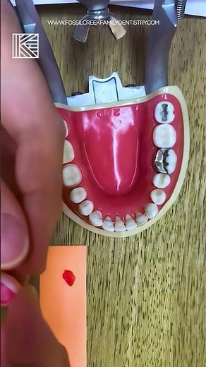 How to Secure a Loose Crown at Home | Dr. Tracy Kirk | Fossil Creek Family Dentistry