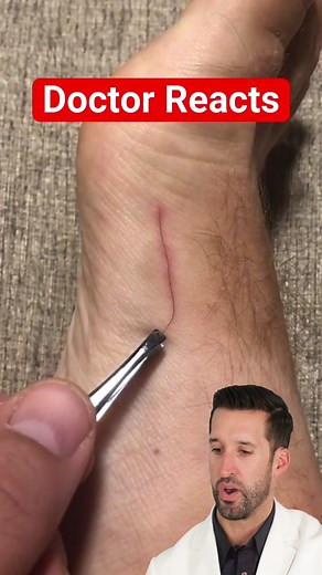Doctor Reacts to “Satisfying” Hair Splinter Removal