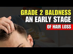 Grade 2 baldness — an early stage of hair loss | Dr Nandini Dadu
