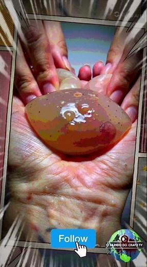 "Satisfying Blackhead Removal – Deep Pimple Popping Close-Up!"