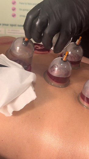 Understanding Cupping Therapy and Its Benefits