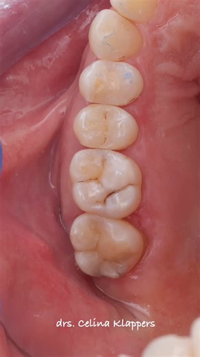Celina Klappers on Instagram: "Biomimetic restorative dentistry is a workflow, not a technique. Absolute isolation with a rubber dam when your goal is predictable adhesive dentistry. This case focuses on: • selective caries removal • preservation of sound enamel and dentin • stress-reduced, layered composite build-ups • restoring biomechanics rather than just morphology By respecting dentin hydration, enamel margins and proper adhesion protocols, we aim to extend restoration longevity and minimi