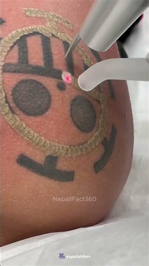 लेजरले ट्याटु कसरी गायब गरिदिन्छ 🤔