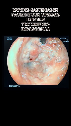 Tratamiento Endoscópico de Varices Gástricas en Paciente con Cirrosis Hepática
