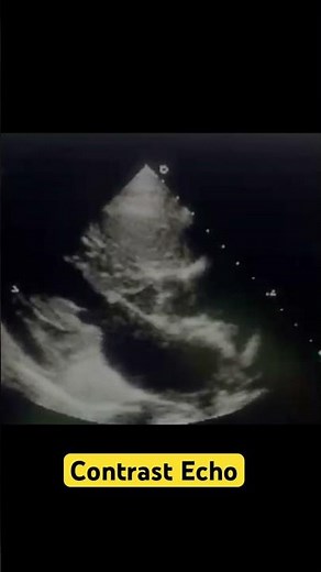 Dilated Coronary Sinus on Echo | Left Persistent Superior Vena Cava | Dye appears in CS than in RV