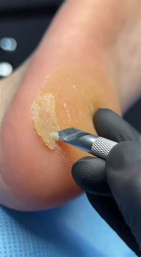 Crunchy Heel Callus Removal ASMR Precision Podiatry Treatment #asmr #satisfying #podiatry #peliculas