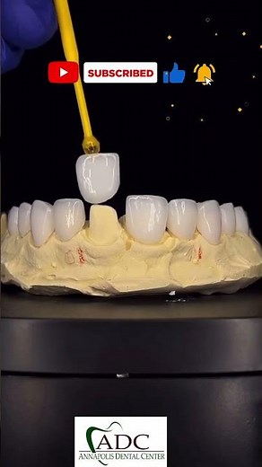 Dental Veneer VS Crown Which ONE Is BEST For You