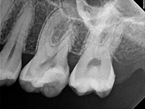 Root Canal Treatment Start to Finish Tooth #14