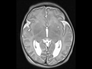 Corpus Callosum Agenesis