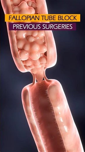 Fallopian Tube Block #pregnancy #baby #shorts