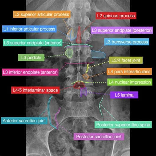 🩻 ​X-Ray Vision: Identifying Lumbar Vertebrae & Joints | Radiology 313. #radiology313 #anatomy #xray