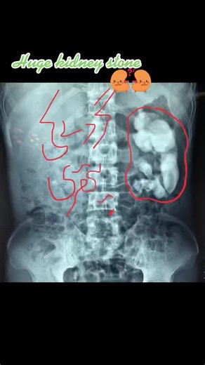 Open Surgery for Kidney Stones by Dr. Sajjad Ahmad