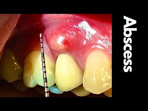 You'll Never Forget Why [GUM SWELLING]