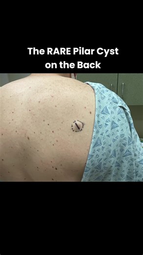 Sandra Lee, MD, FAAD, FAACS | 90% of pilar cysts appear on the scalp, so it was nice to see a cyst on this patient's back that was so satisfying to remove ✌️❤️💥⁠ ⁠ Have... | Instagram