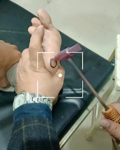 Corn remove instant #reelsvideo #memes #ayurveda #reels #viral #medical | Vaidya Pawan Kaushik