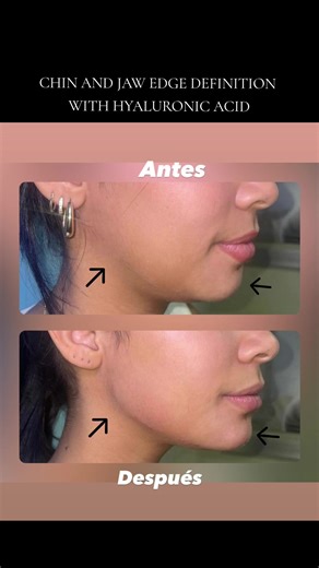 #chindefinition #jawlinedefinition #hyaluronicacid 💥 #drwalkirisrobles #thetummytuckqueen®️ #plasticsurgery #plasticsurgeon www.drwalkirisrobles.com @drwalkirisrobles @thetummytuckqueen ®️ board certified Plastic Surgeon 🏅 in Dominican Republic 🇩🇴 👑 Liposuction 👑 TummyTuck 👑 Brazilian But Lift (BBL) 👑 Breast Implants 👑 Breast Reduction 👑 Facial Harmonization 👑 Facial Rejuvenation 👑 Lip fillers 👑 Full face 👑 And many other personalized procedures Links in the BIO 💋