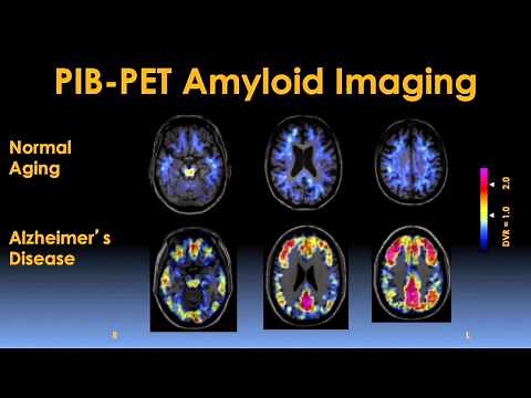 Early Detection and Prevention of Alzheimer's Disease Video - Brigham and Women's Hospital
